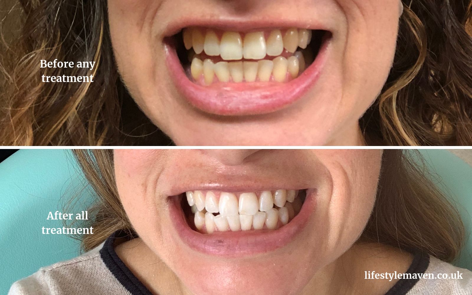 Is Professional Teeth Whitening Worth The Money Home Kit Vs Professional