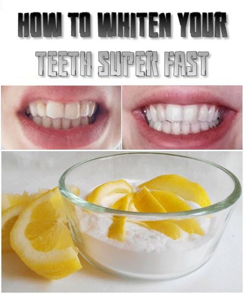 Pin On Teeth Whitening